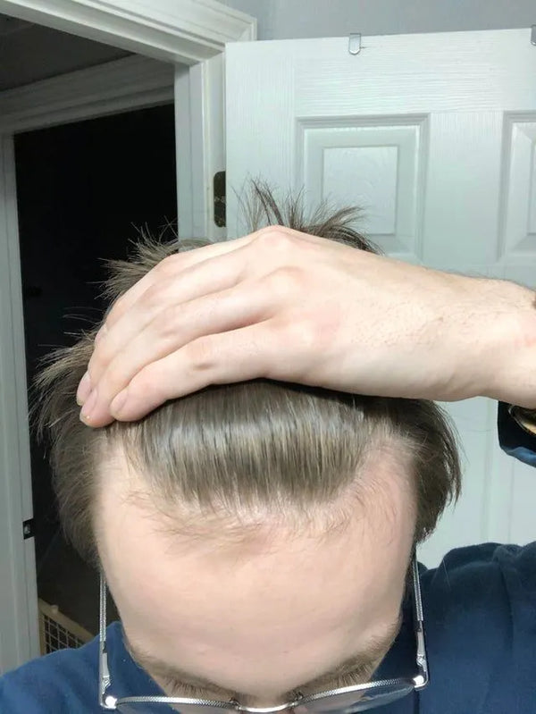 Receding hairline